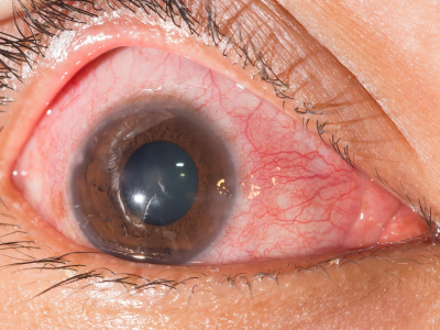 Bolesti prednjeg segmenta oka